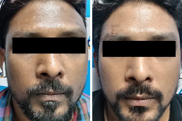 Hydrafacial Treatment